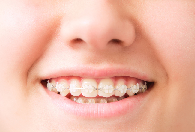 Clear Braces vs. Traditional Braces: Which are Right for You?