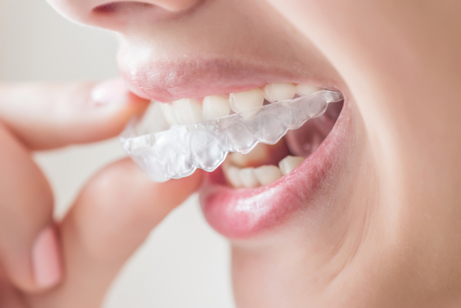 What is Invisalign