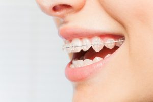 Pros and Cons of Clear Braces
