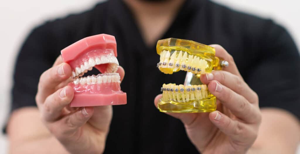 How to Care for Invisalign Aligners for Kids?