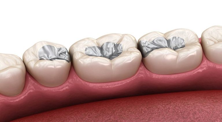 How Long Does Dental Filling Last?