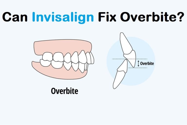Can Invisalign Fix Overbite? Understanding How It Works