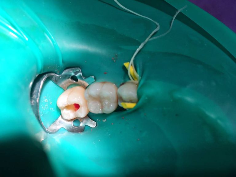 Step-by-Step Overview of the Pulpotomy Procedure!