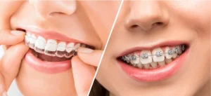 invisalign vs braces