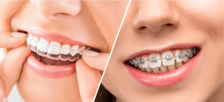 Is Invisalign Really Faster Than Braces? Here’s What You Need to Know
