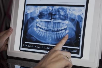 Are Dental X-rays Safe? Breaking Down the Facts