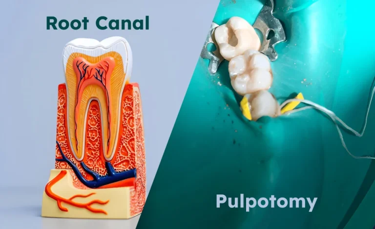 Pulpotomy vs Root Canal: What’s the Difference?