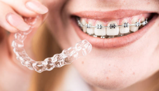 What Are the Benefits of Clear Braces for Kids and Teens?