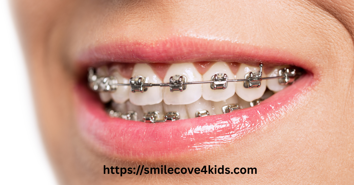 How Long Do You Have To Wear A Retainer After Braces?