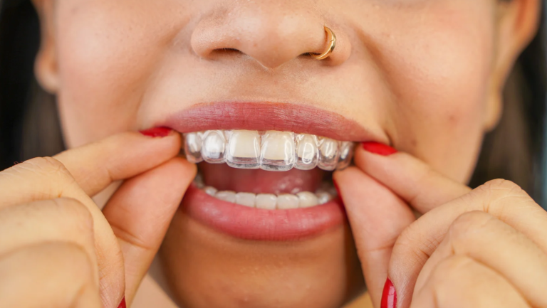Where Can You Get the Best Invisalign Treatment in Tampa, FL?
