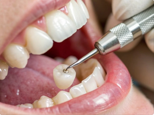 What Are the Best Dental Filling Options in Tampa, FL?