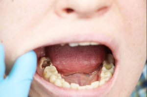 How to Prevent Cavities in Kids with Simple Home Habits