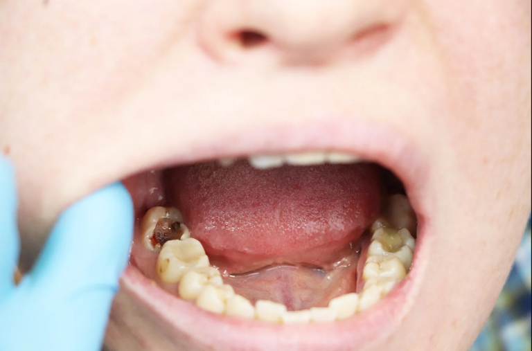 How to Prevent Cavities in Kids with Simple Home Habits? 