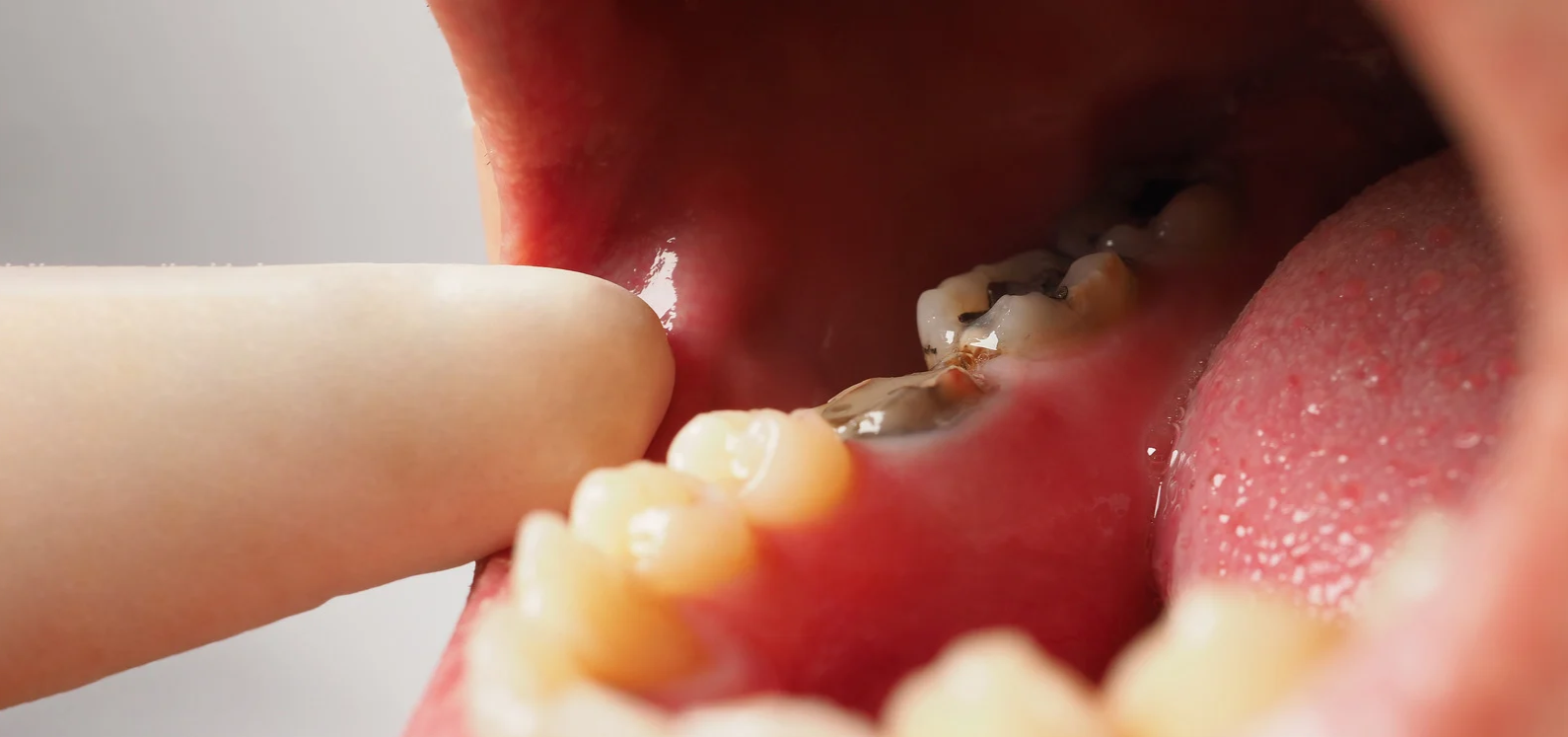 What Are the Early Signs of Tooth Decay in Children?