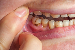 How Can a Child’s Diet Affect Their Risk of Cavities