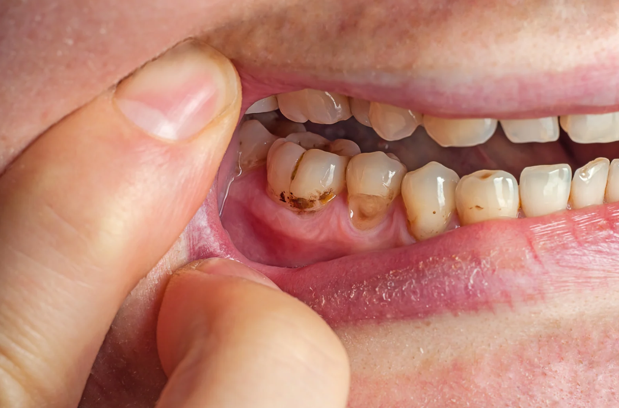 How Can a Child’s Diet Affect Their Risk of Cavities